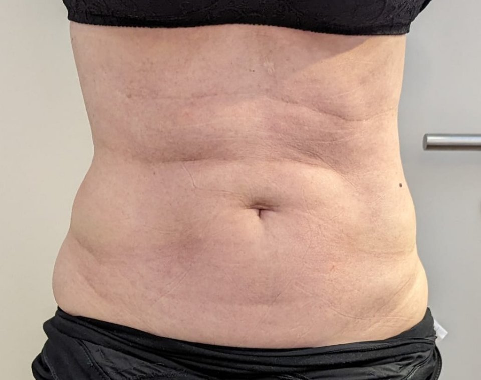 Vorher-Aufnahme Cryo-BodyShape, Zone Bauch