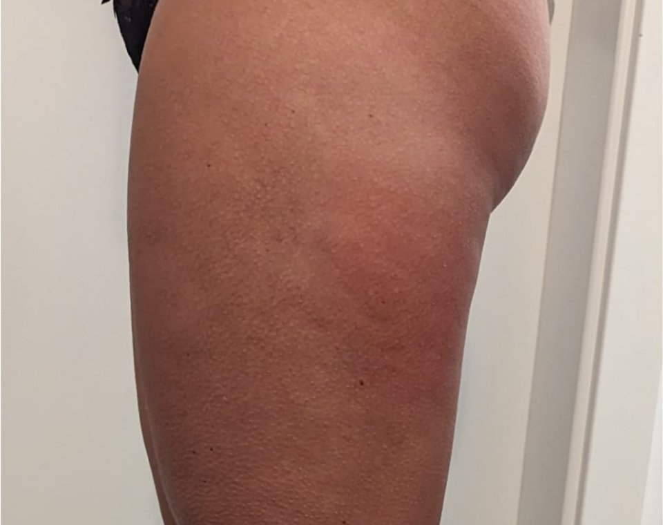Nachher-Aufnahme Cryo-BodyShape, Zone Po