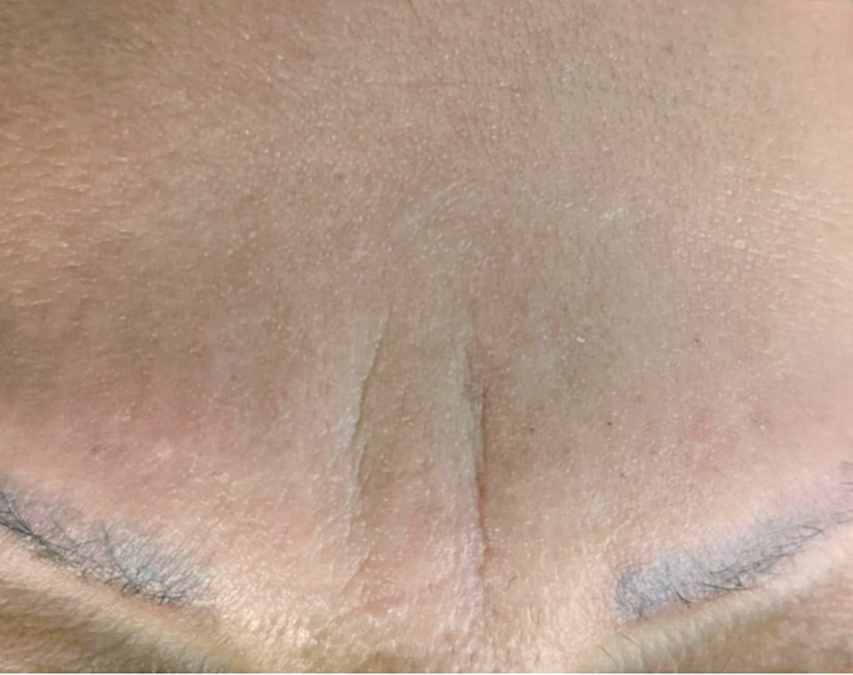 Nachher-Aufnahme Cryo-Facial, Zone Stirn