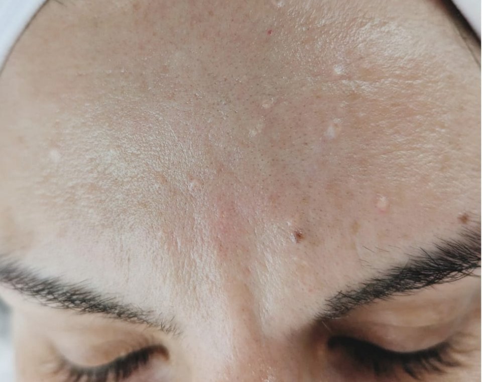 Nachher-Aufnahme Cryo-Facial, Zone Stirn