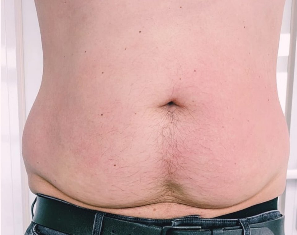 Nachher-Aufnahme Cryo-Metabolic, Zone Bauch